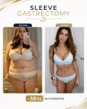 Before and after gastric sleeve surgery at Estexper Clinic – 38 kg weight loss in 9 months