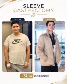 Before and after gastric sleeve surgery at Estexper Clinic – 31 kg weight loss in 9 months