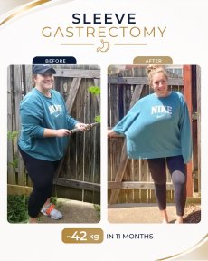 Gastric sleeve surgery before and after at Estexper Clinic – 42 kg weight loss in 11 months