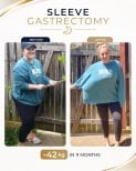 Gastric sleeve surgery before and after at Estexper Clinic – 42 kg weight loss in 11 months
