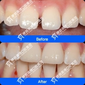 Результат до та після встановлення вінірами в Shanghai Y+bo Dental Clinic, покращення усмішки