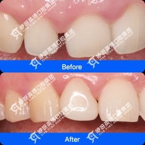 Результат встановлення вінірів до і після у Shanghai Y+bo Dental Clinic, покращення передніх зубів