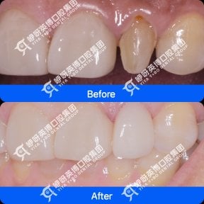 Результат до та після встановлення вініров у Shanghai Y+bo Dental Clinic, покращення передніх зубів