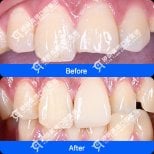 До та після встановлення вініров у Shanghai Y+bo Dental Clinic – покращена форма зубів