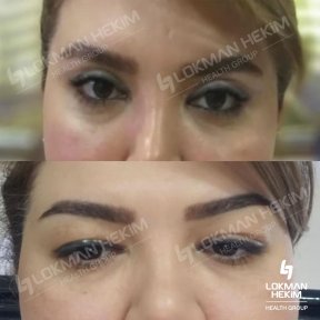 before-after photo brow-lift