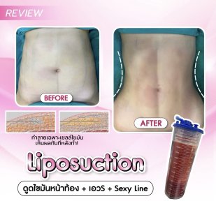 Before and after Vaser liposuction results at Somchai Clinic, visible abdominal contouring