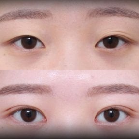 Vorher-nachher-Ergebnis der Blepharoplastik bei VG Plastic Surgery, Lidkorrektur