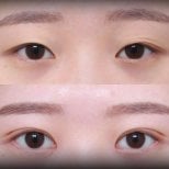 Before and after blepharoplasty results at VG Plastic Surgery, eyelid correction improvement