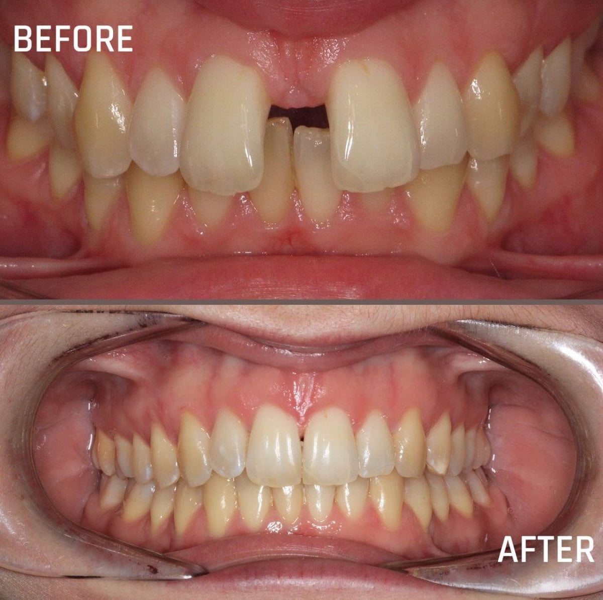 نتائج قبل وبعد تقويم الأسنان في CIVICO DENTAL CARE MEXICALI، تحسين اصطفاف الأسنان
