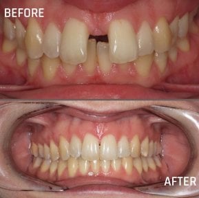 before-after photo braces