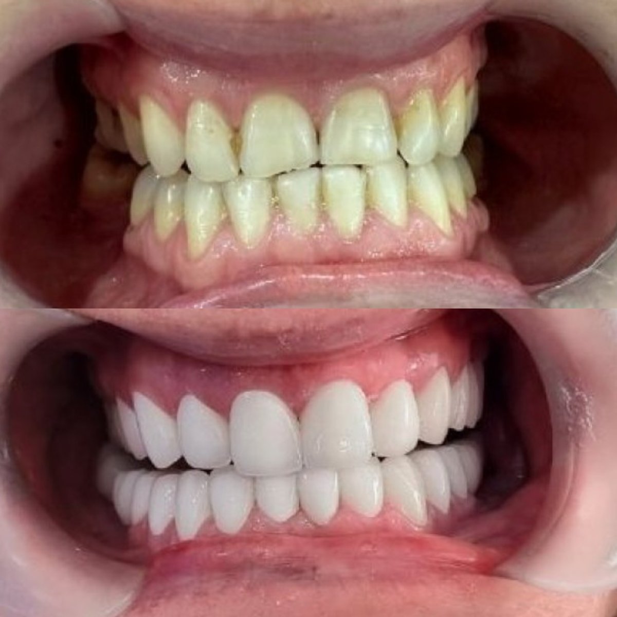 نتائج قبل وبعد الفينير في عيادة Dr. Smile Dental Clinic، تحول الابتسامة بنتائج طبيعية