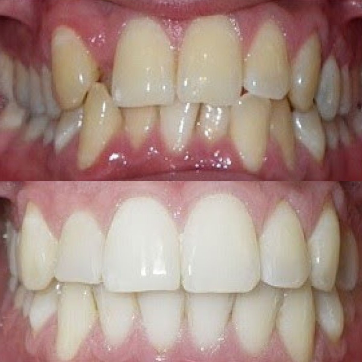 نتائج قبل وبعد الفينير في عيادة Dr. Smile Dental Clinic – أسنان أكثر بياضًا وانتظامًا