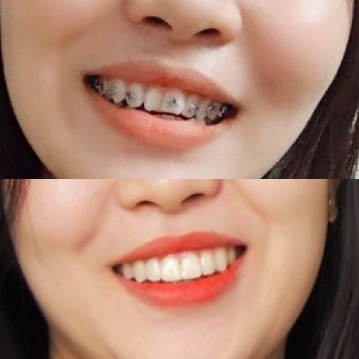 Resultados antes y después de brackets en Dr. Smile Dental Clinic – alineación dental mejorada