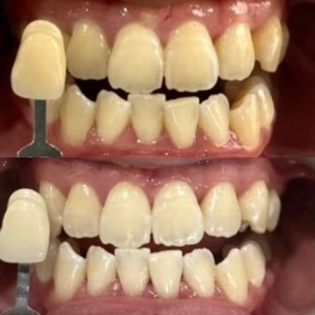 نتائج تنظيف الأسنان (إزالة الجير) قبل وبعد في عيادة Dr. Smile Dental Clinic، ابتسامة أكثر بياضًا