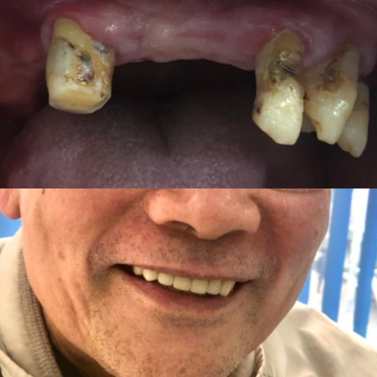 Resultados antes y después de dentadura en Dr. Smile Dental Clinic – sonrisa restaurada