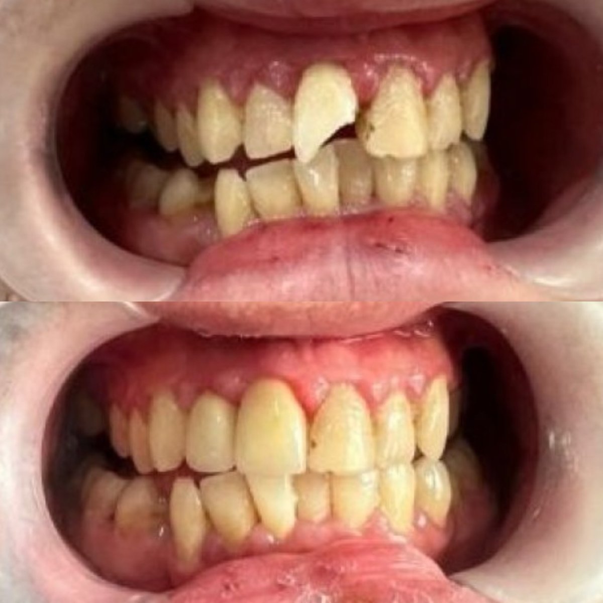 Resultados antes y después de unión dental para reparar dientes astillados en Dr. Smile Dental Clinic