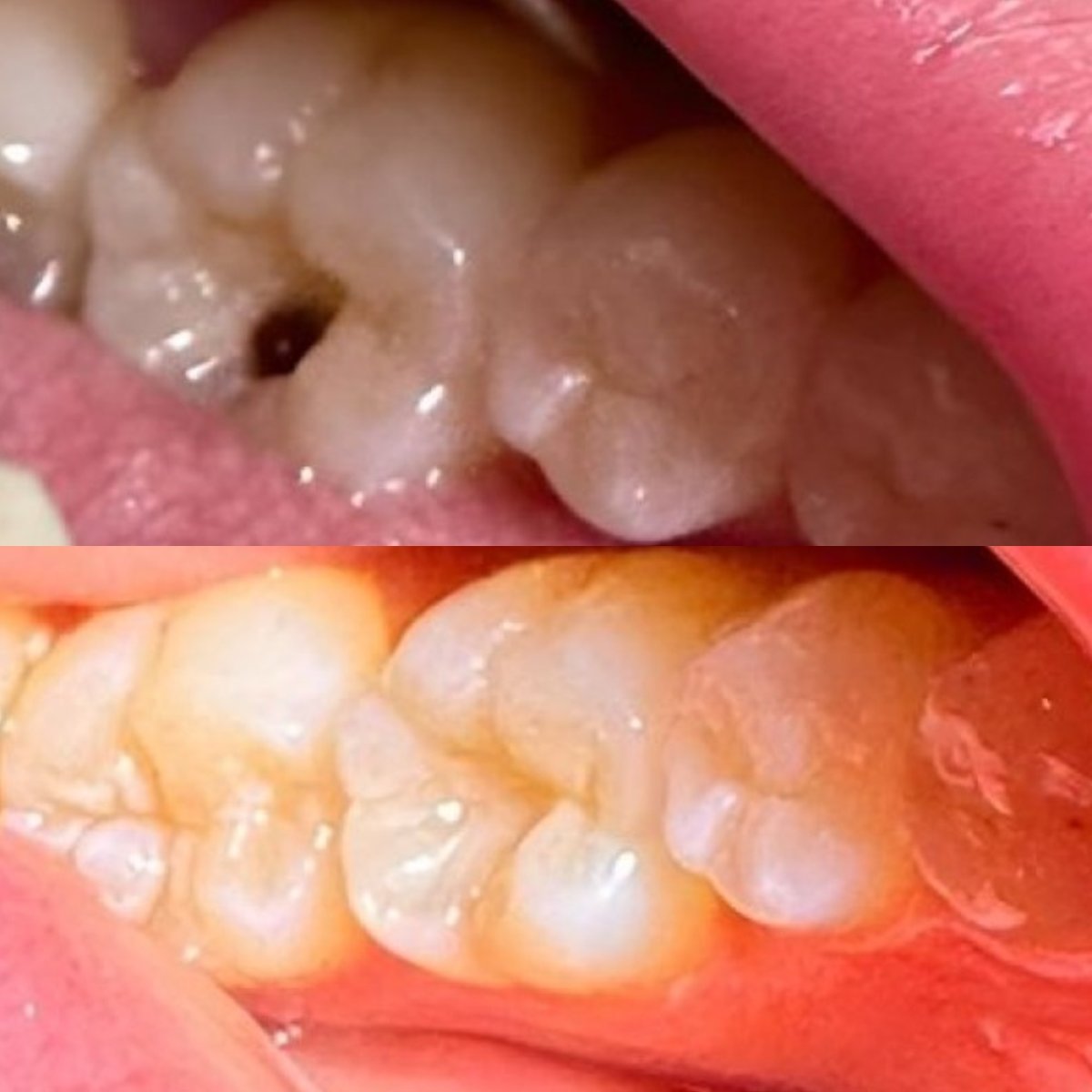 نتيجة قبل وبعد حشو تجميلي في عيادة Dr. Smile Dental Clinic لعلاج تسوس الأسنان
