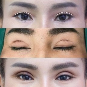 Blepharoplasty before and after results at Asia Cosmetic Hospital, eyelid correction procedure