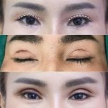 Blepharoplasty before and after results at Asia Cosmetic Hospital, eyelid correction procedure