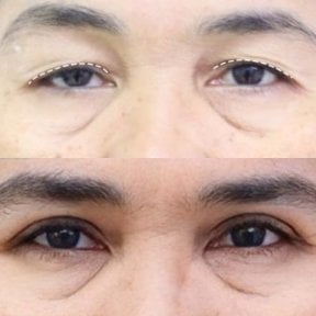 Before and after blepharoplasty results at Asia Cosmetic Hospital, eyelid correction procedure