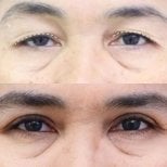 Before and after blepharoplasty results at Asia Cosmetic Hospital, eyelid correction procedure