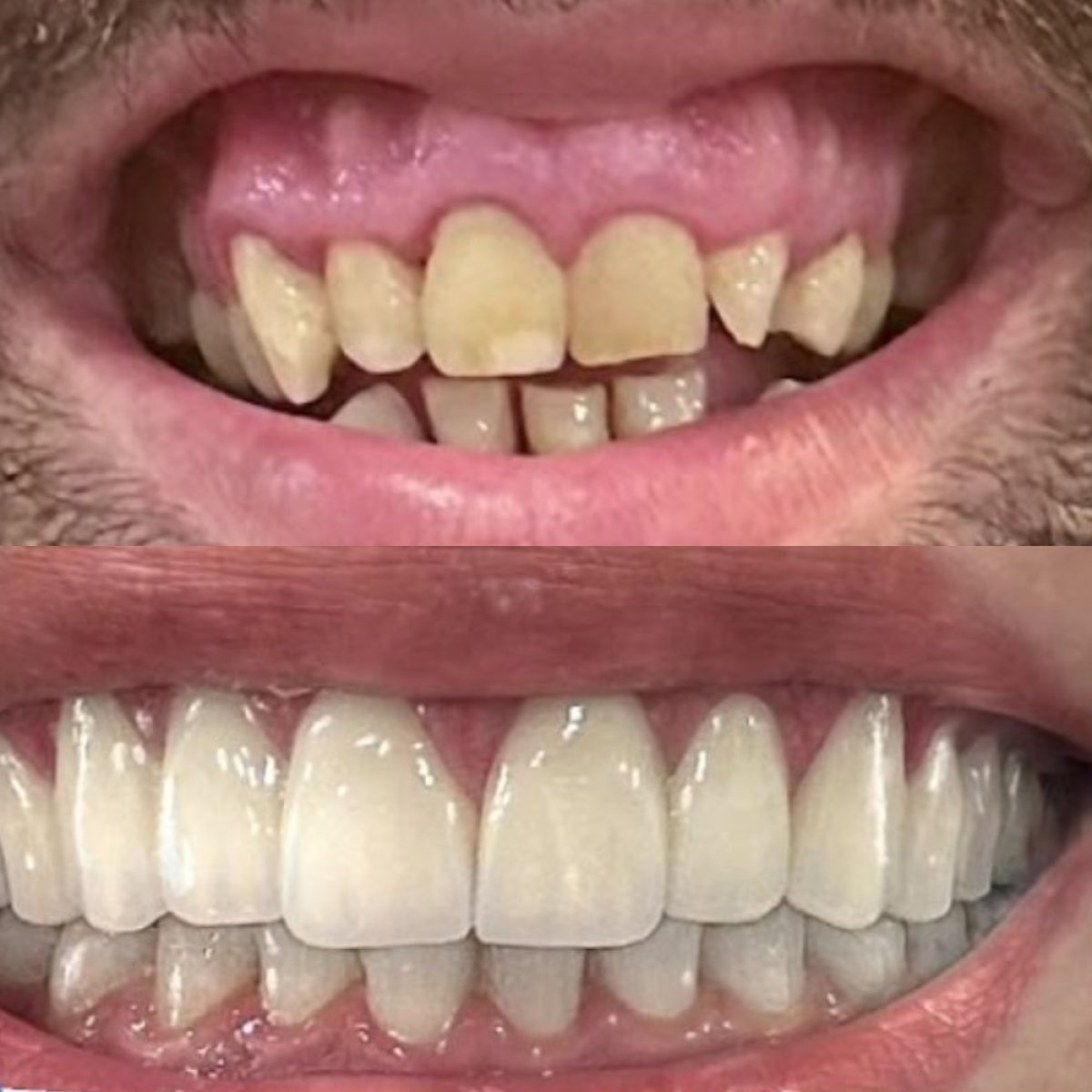 نتائج قبل وبعد جينجيفيكتومي في 360 Dental Clinic، تحسين اللثة وابتسامة أجمل