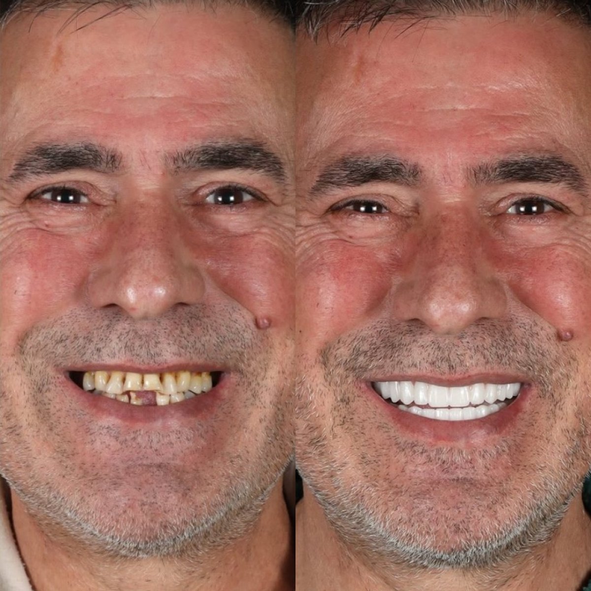 نتائج قبل وبعد ابتسامة هوليود في عيادة Qualident – تحول كامل للابتسامة