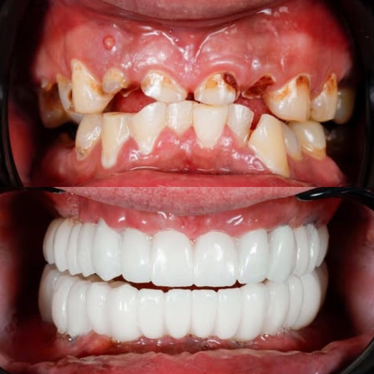 نتائج قبل وبعد تجميل الابتسامة بزرع الأسنان في عيادة Qualident Dental Clinic