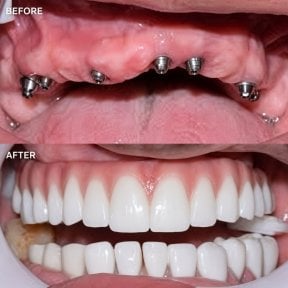 before-after photo implantacia-zuba