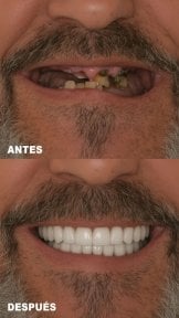before-after photo implantacia-zuba