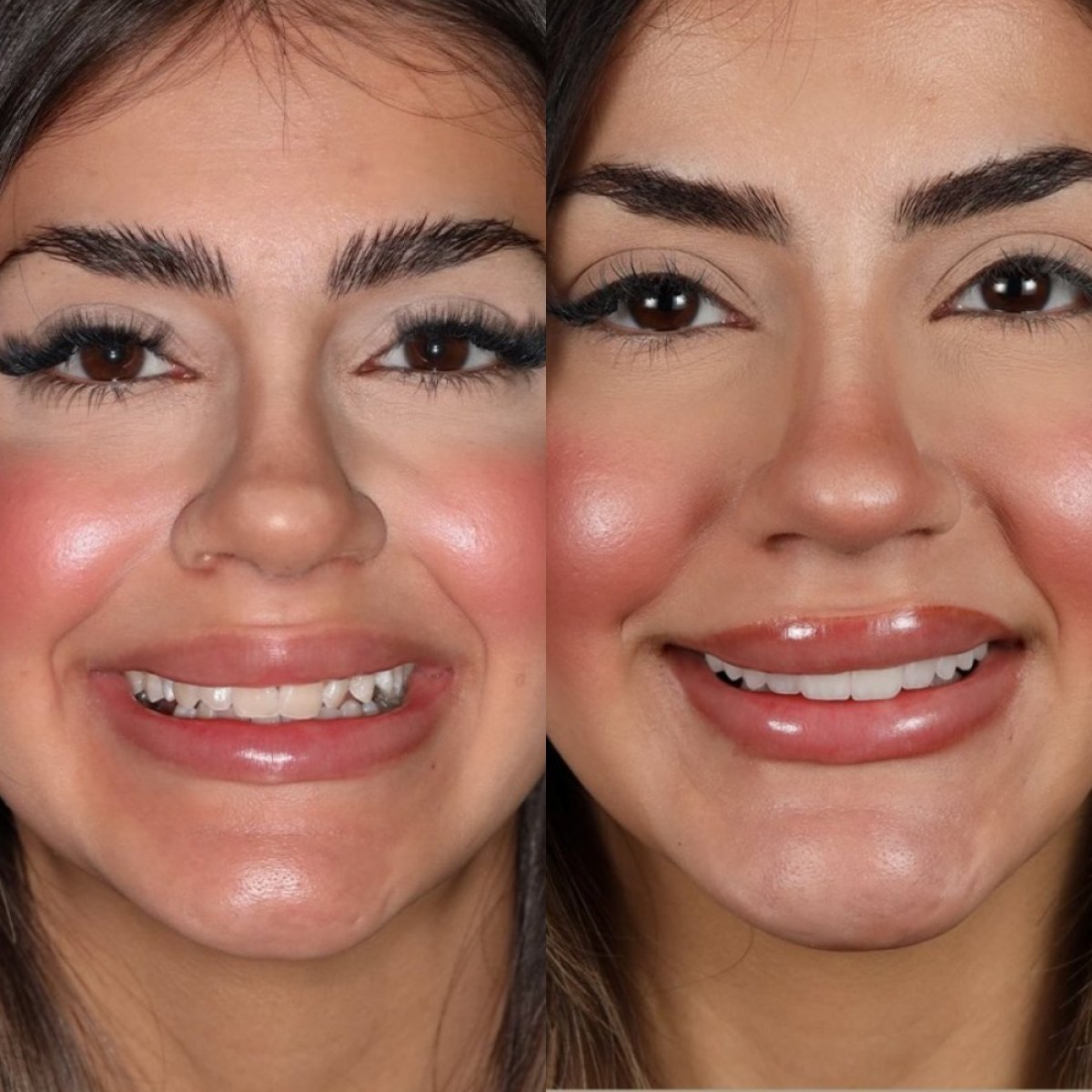 Antes y después de carillas dentales en Qualident Dental Clinic: resultados de sonrisa