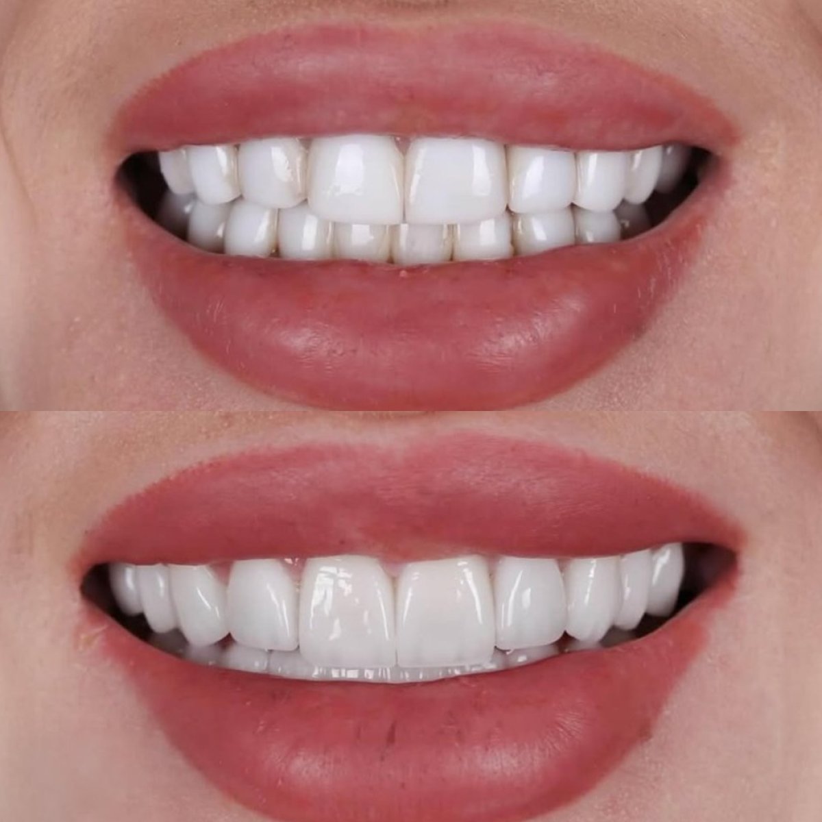 Resultado antes y después de carillas en Qualident Dental Clinic – sonrisa mejorada
