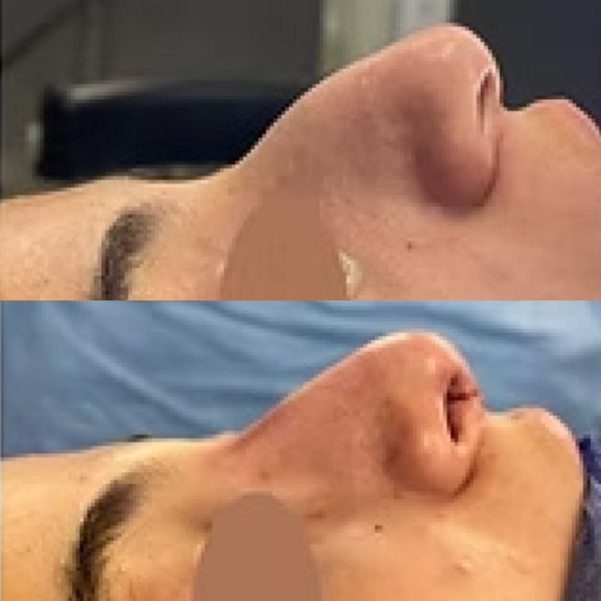 Resultado de rinoplastia antes y después en Prof. Dr. Mohamed Hazem Abdelazeem, clínica