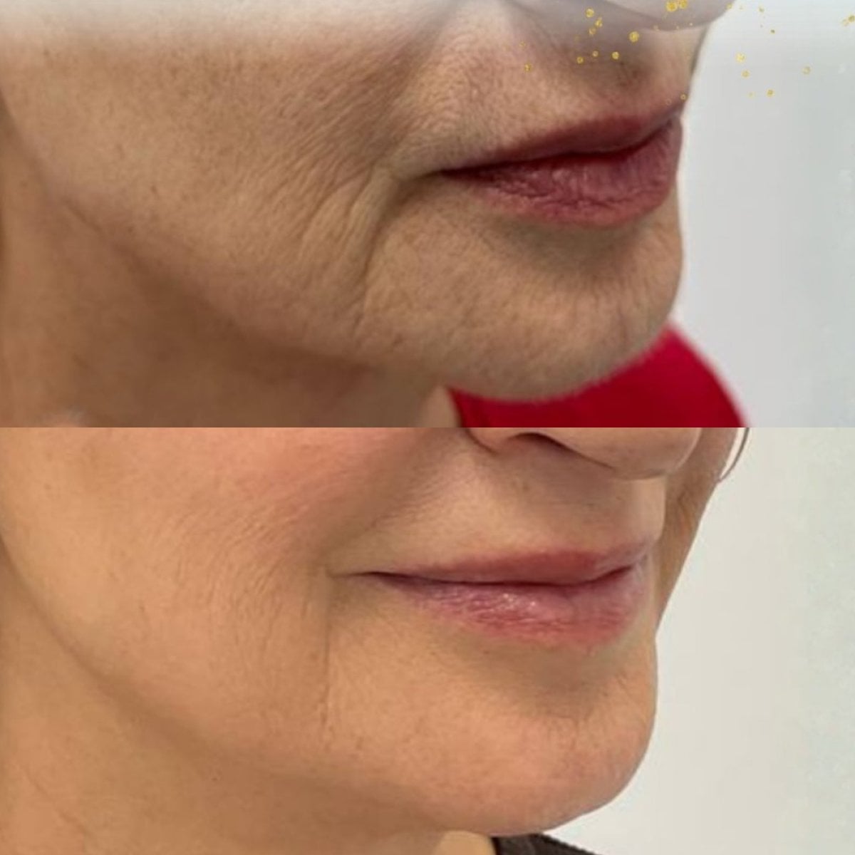 قبل وبعد حقن الفيلر في DERMA CLINIC SPAIN، تقليل التجاعيد ونعومة البشرة