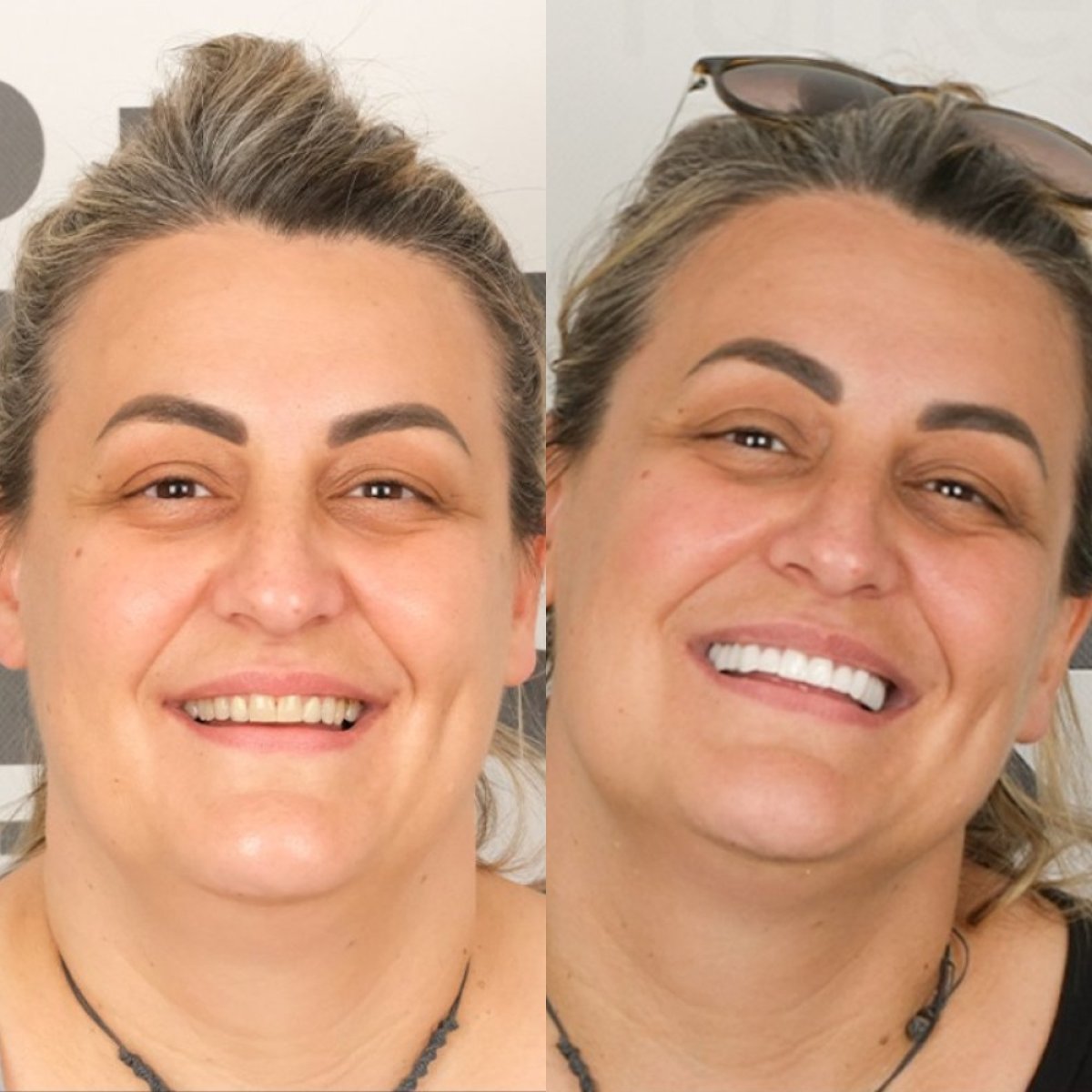 Resultados de blanqueamiento dental láser antes y después en SmilesTurkey – sonrisa más brillante