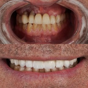 before-after photo all-on-6-dental-implants