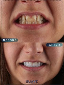 before-after photo emax-veneers