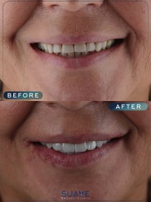 before-after photo emax-veneers