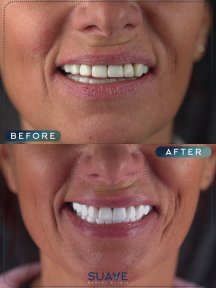 before-after photo emax-veneers