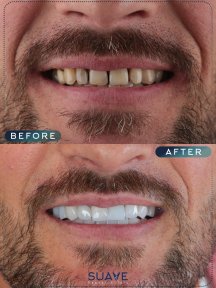 before-after photo emax-veneers