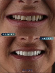 before-after photo emax-veneers