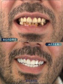 before-after photo installation-of-a-veneer