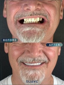 before-after photo installation-of-a-veneer