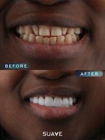 before-after photo installation-of-a-veneer