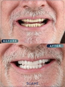 before-after photo installation-of-a-veneer
