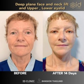 before-after photo tightening-of-facial-skin-facelift