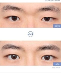 before-after photo upper-eyelid-surgery
