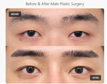before-after photo upper-eyelid-surgery