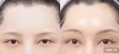 before-after photo upper-eyelid-surgery