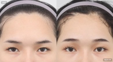 before-after photo upper-eyelid-surgery